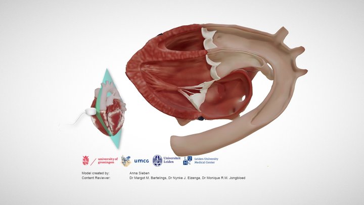 Transposition of the Great Arteries, Long Axis – Modello 3D gratuito STL