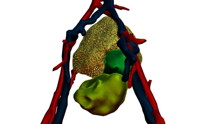 Rabdomiosarcoma 3D Model
