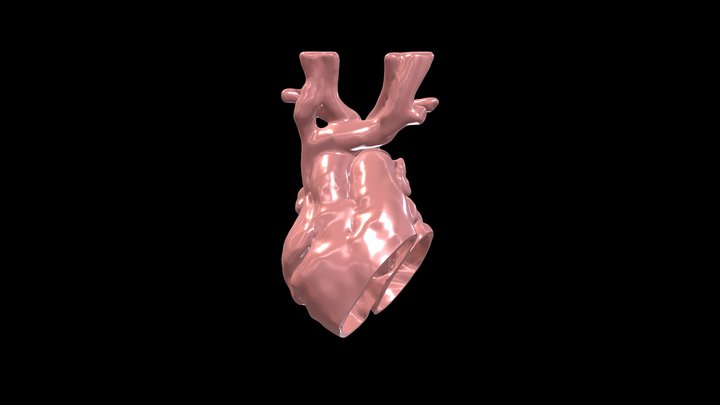 Case 33: Coronal Cut 3D Model