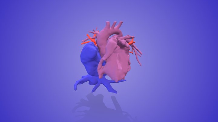 Tricuspid Atresia – Free 3D Model STL