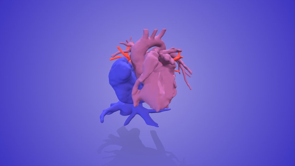 Tricuspid Atresia
