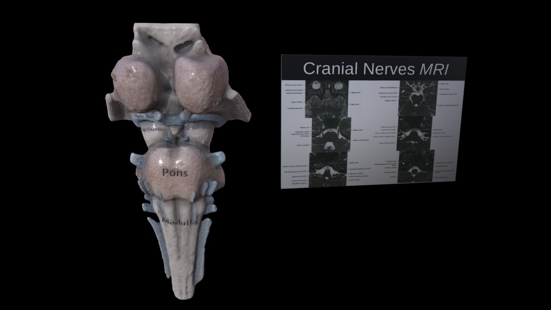 Brainstem Model with MRI Corelation - 3D model by tl0615 [f83d7f7 ...