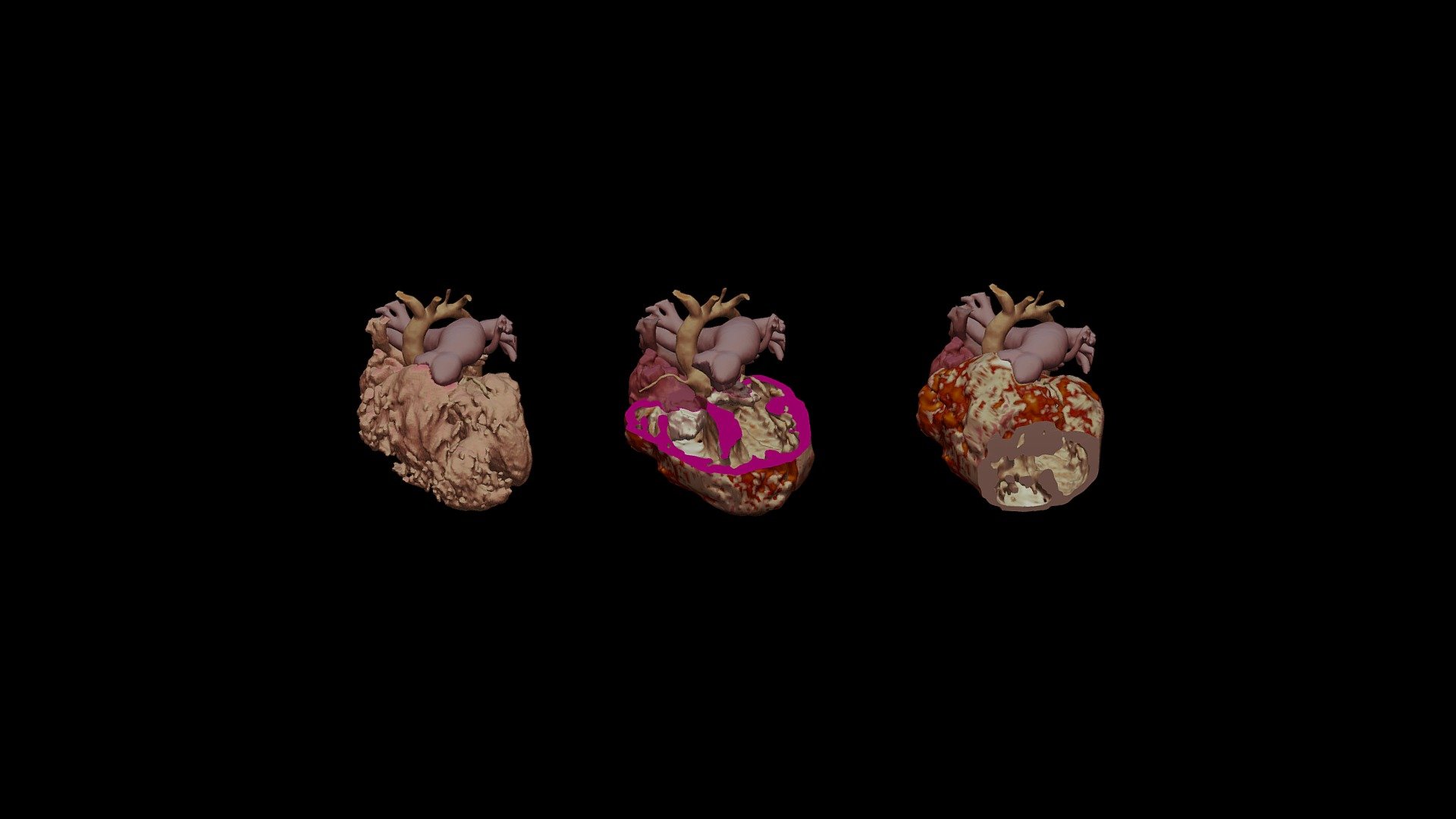 3DModel-VSD - 3D model by 3DCardio [f87fbcd] - Sketchfab