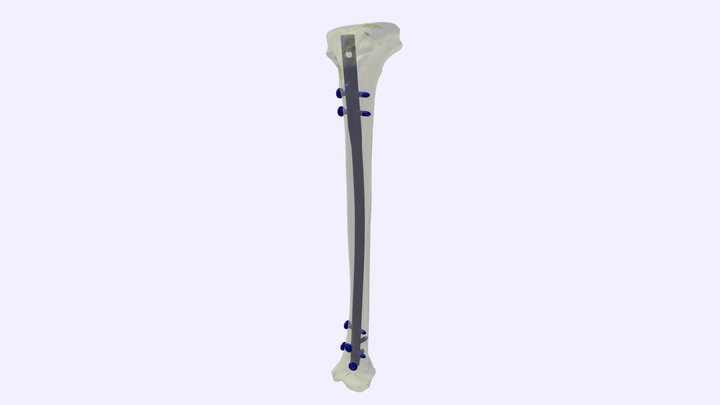 Proximal Tibial Nail (PTN) 3D Model