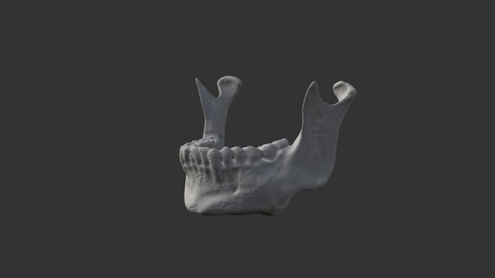 Tumor Mandibular 3D Model