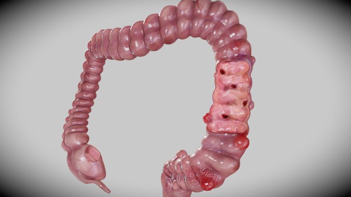 Diverticulosis and diverticulitis 3D Model