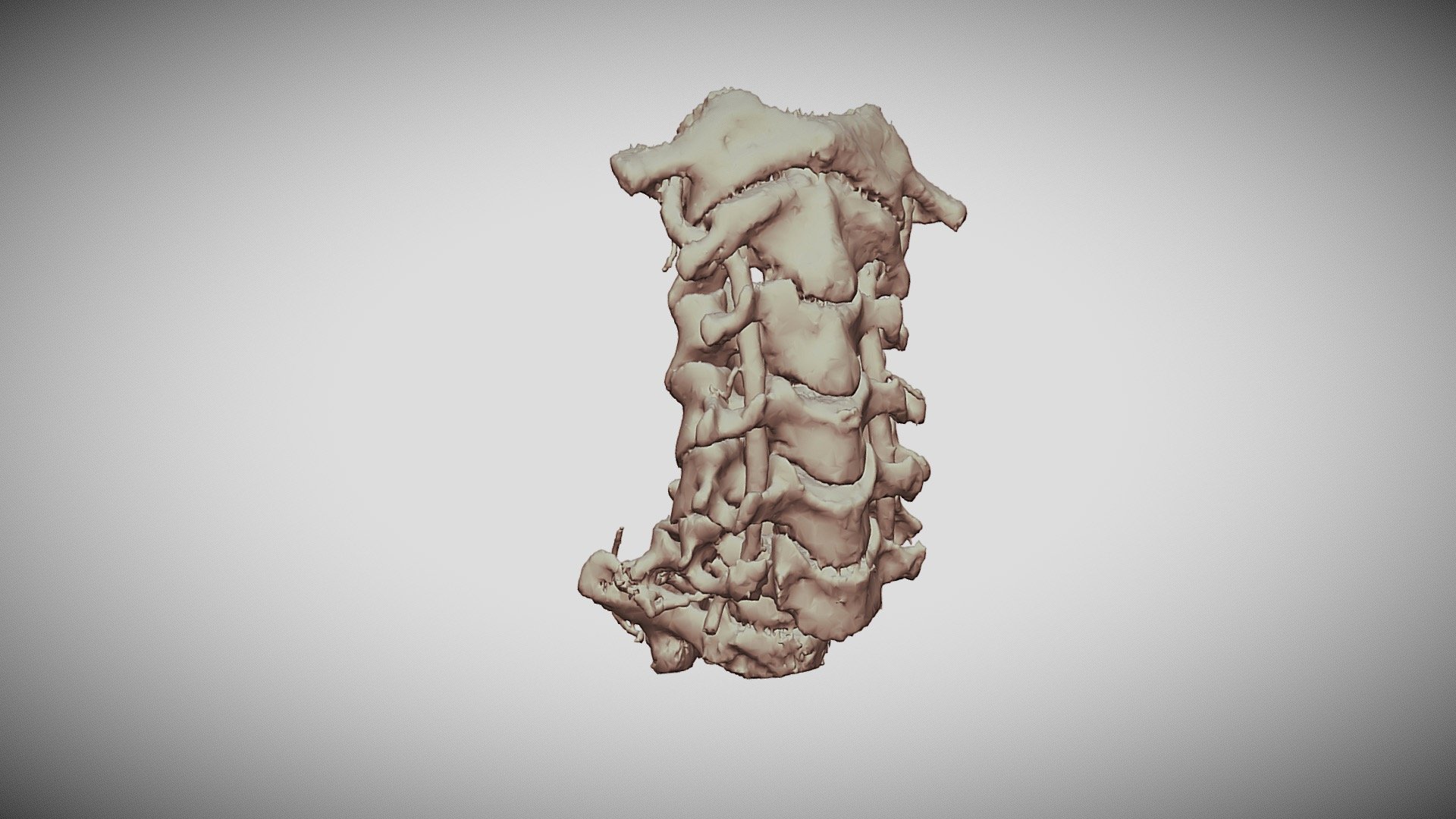 AOspine_Subaxial_TypeC_C6 - 3D model by E_Schulz [fa1e067] - Sketchfab