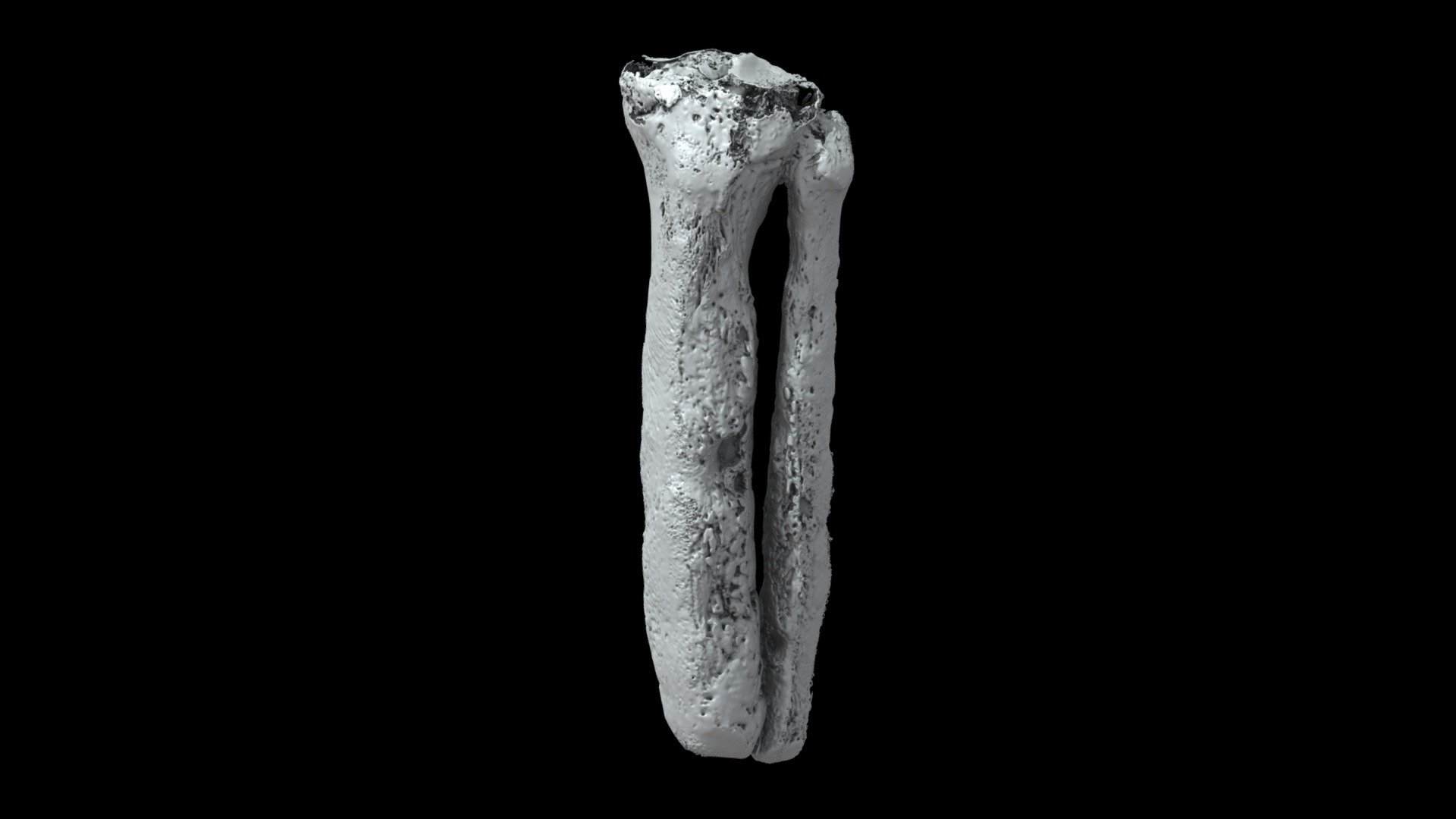 Tibia & Fibula with Osteomyelitis (VCU_3D_5248) - 3D model by Virtual ...