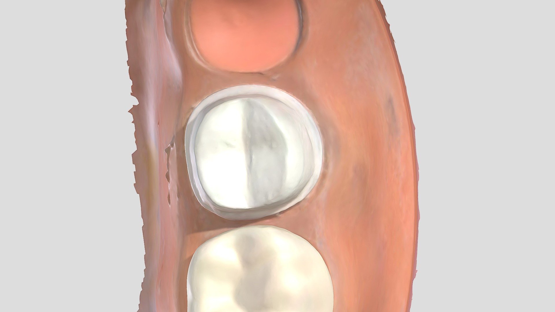 #18 All Ceramic Zirconia Prep — Sketchfab embed 3D viewer