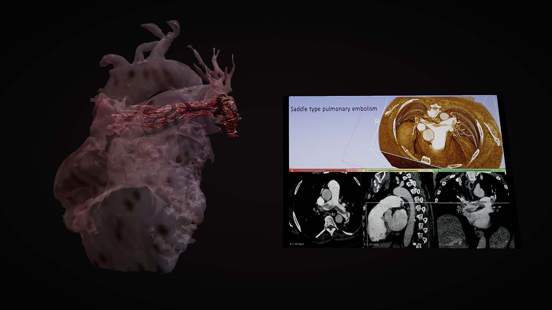 Pulmonary Embolism