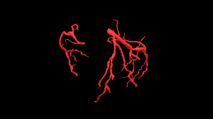 Heart0069 Coronary Arteries – Gratis 3D-model STL