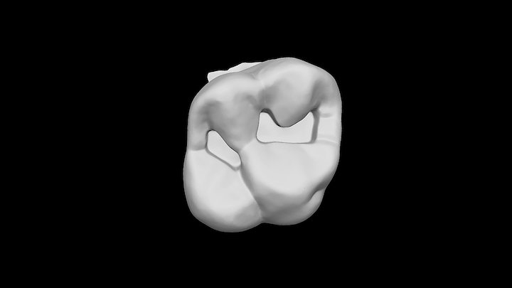 Tooth #3 Class I Preparation 3D Model