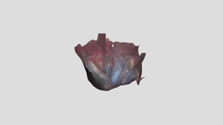 Occipital transtentorial: pineal region 3D Model
