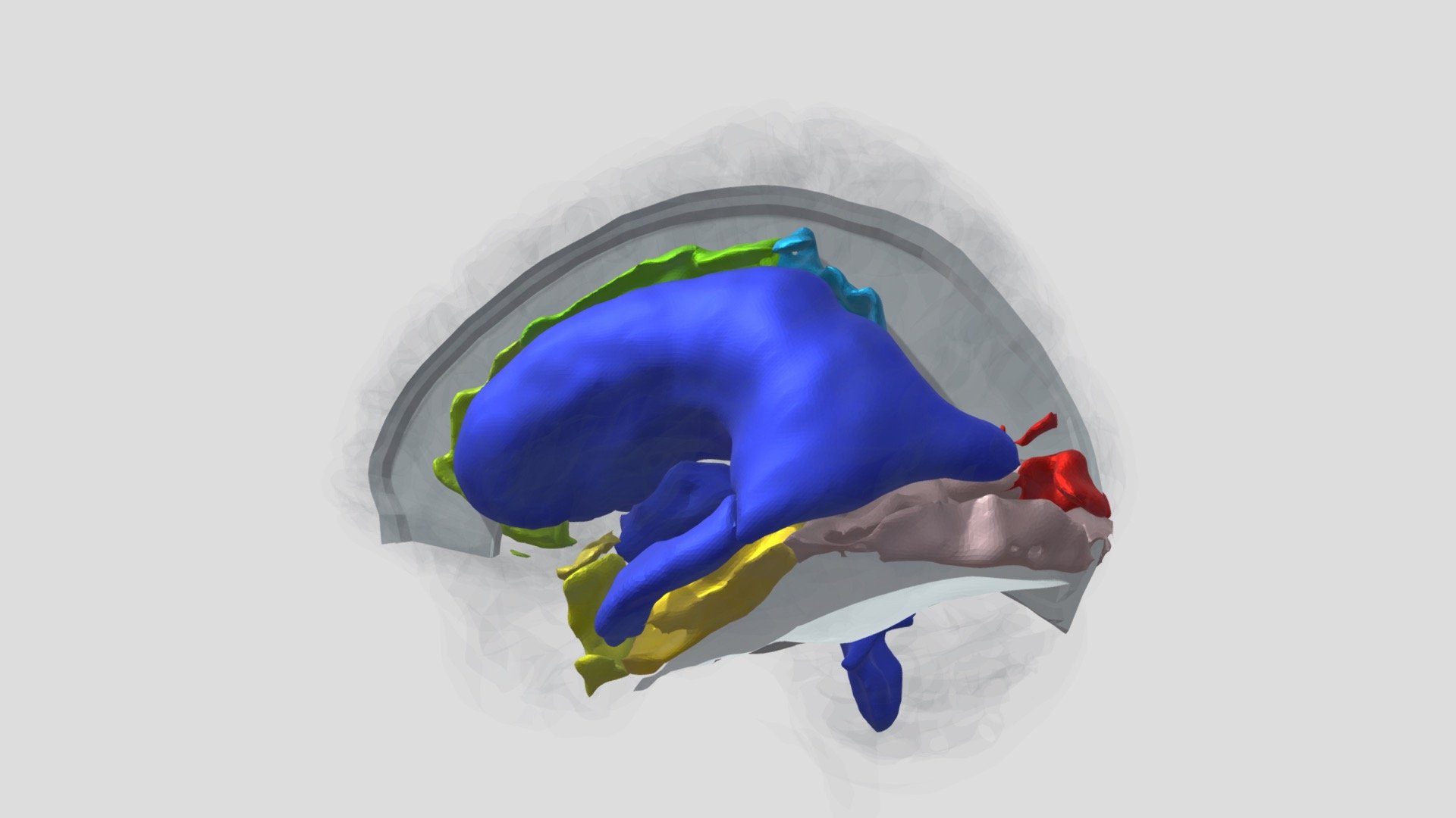 Showing affected areas in NPH - 3D model by 3D Neurosurgery ...