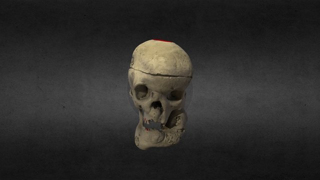 Acromegalic Skull 3D Model