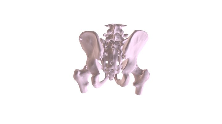 Fractured bone 3D Model