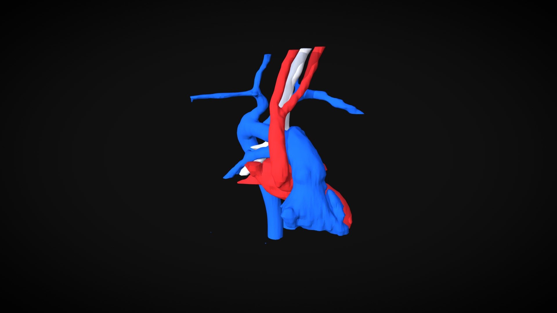 Interupted aortic arch