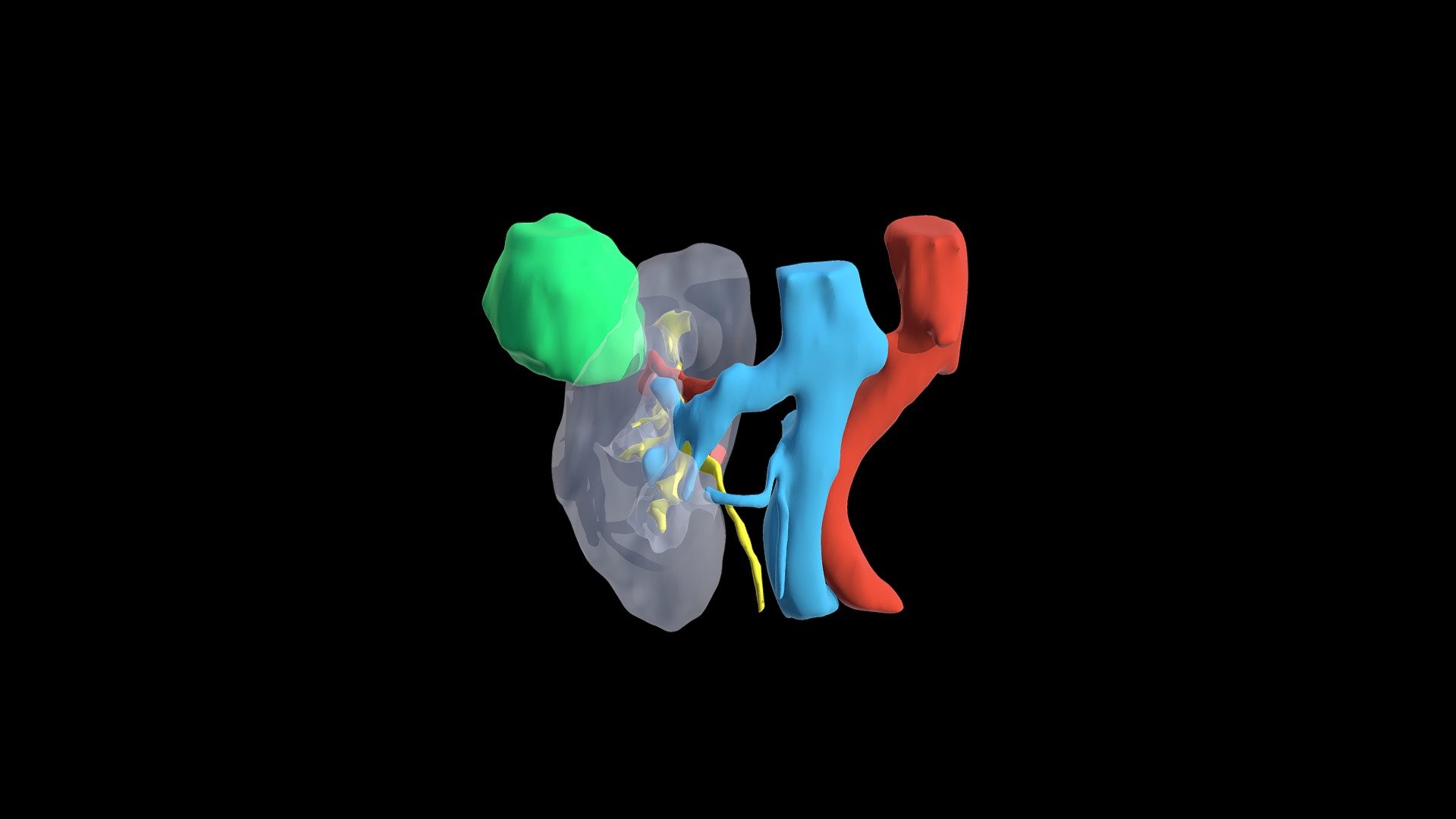 Right Renal Tumor 3D Model By Cirurgic3D neorenal fd48d60
