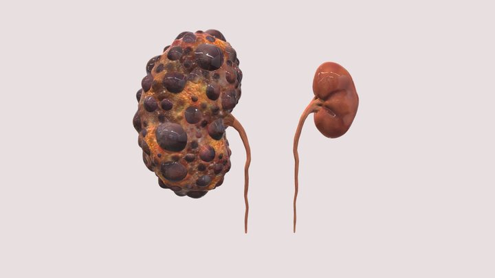 Polycystic Kidney Disease 3D Model
