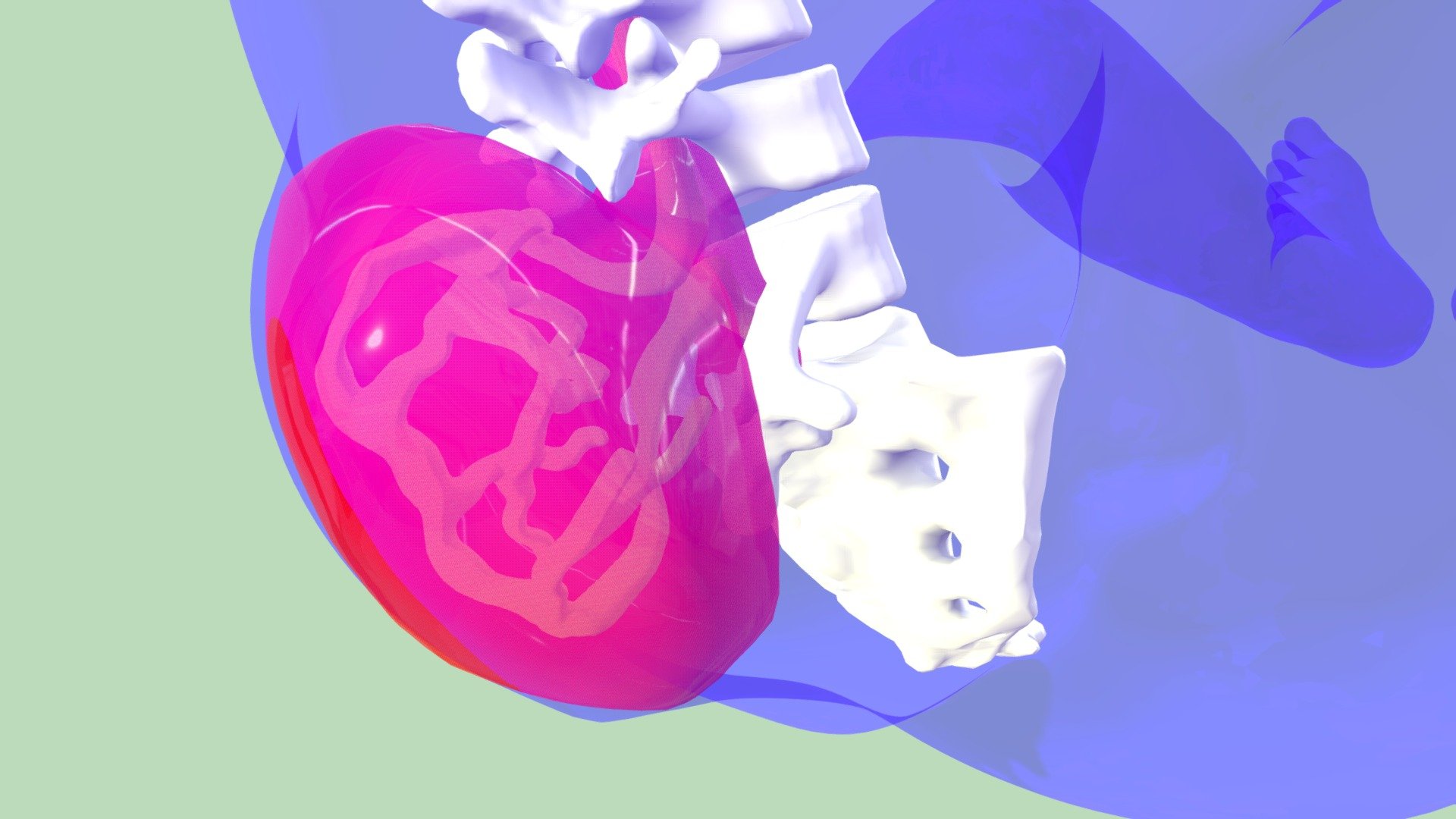 Spina Bifida (V2) - 3D model by tnisi6789 [fd6688f] - Sketchfab