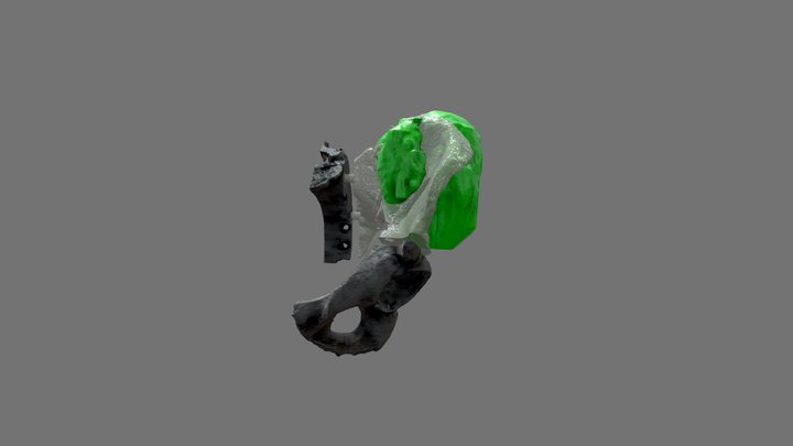 Pelvic Mass 3D Model