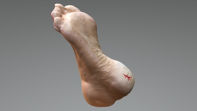 O&P Foot Problems 3D Model