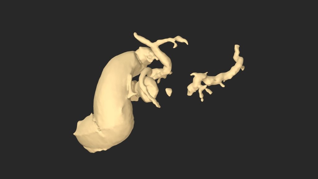 Annular Pancreas with Chronic Pancreatitis