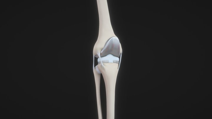 Knee Replacement 3D Model