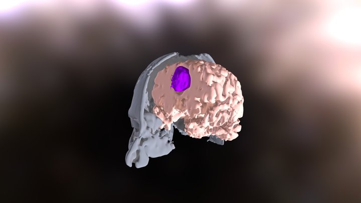 tumor 3D Model