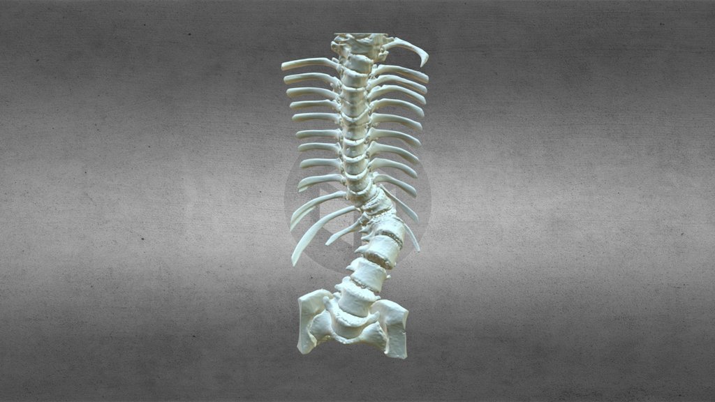 Scoliosis