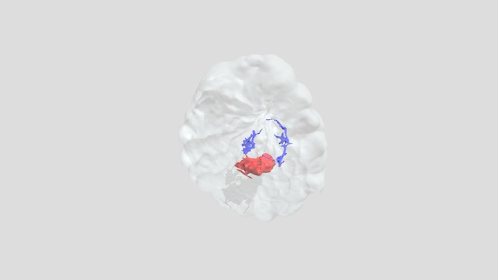 DCIS and invasive breast carcinoma 3D Model