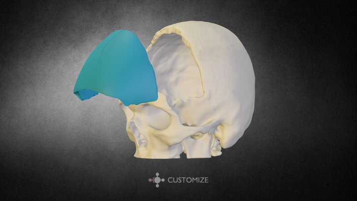 Cranioplastia Bilateral Customize - MG - Brasil 3D Model