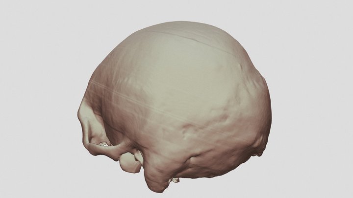Skull Trauma 3D Model