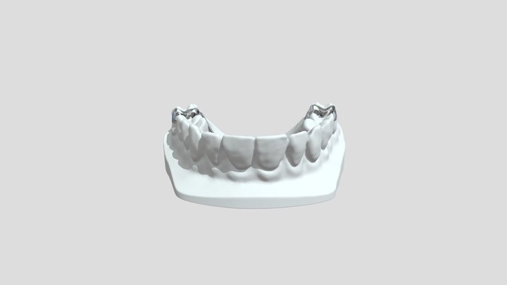 Rapid Palatal Expander 3D Model