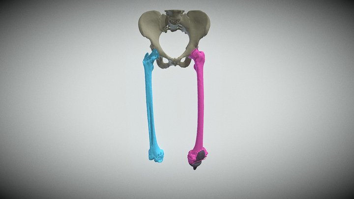 Segmentation of Femurs, Pelvis, and Knee Implant 3D Model