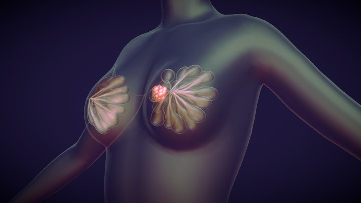 Cancer de Mama 3D Model