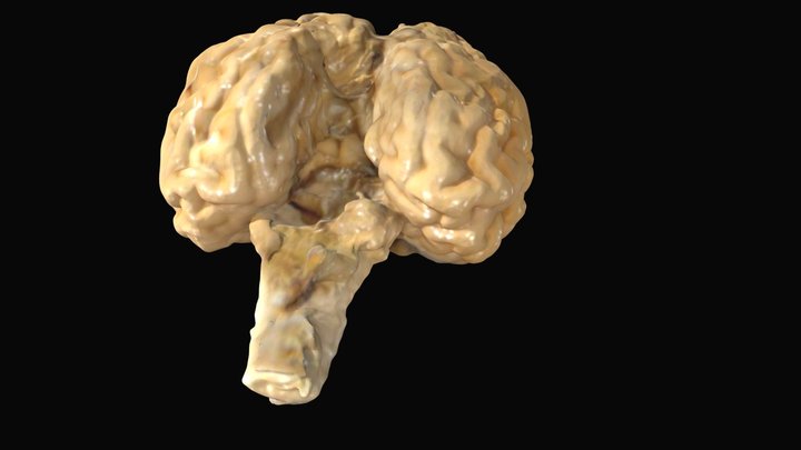 Cerebellar Hypoplasia 3D Model