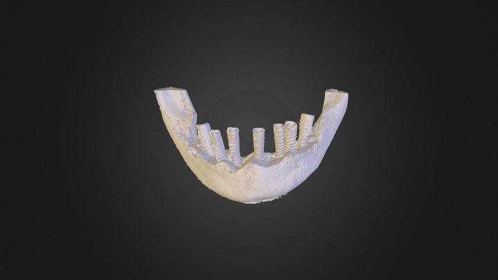 Post-op Implants and Bone (merged mask) 3D Model