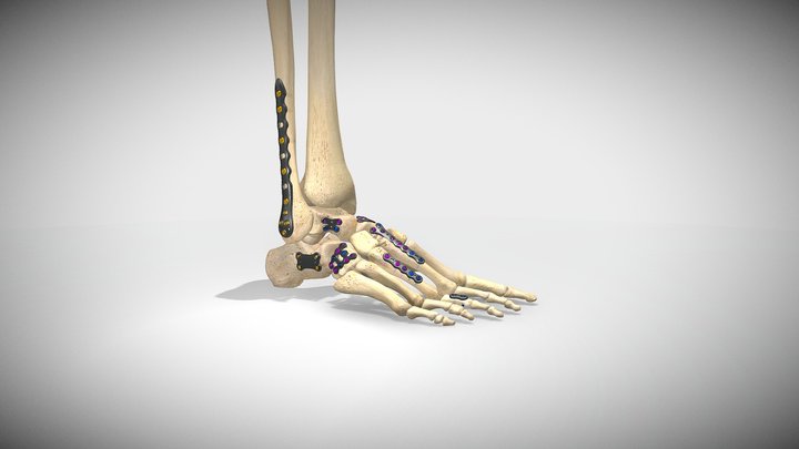 Foot With Implants 3D Model