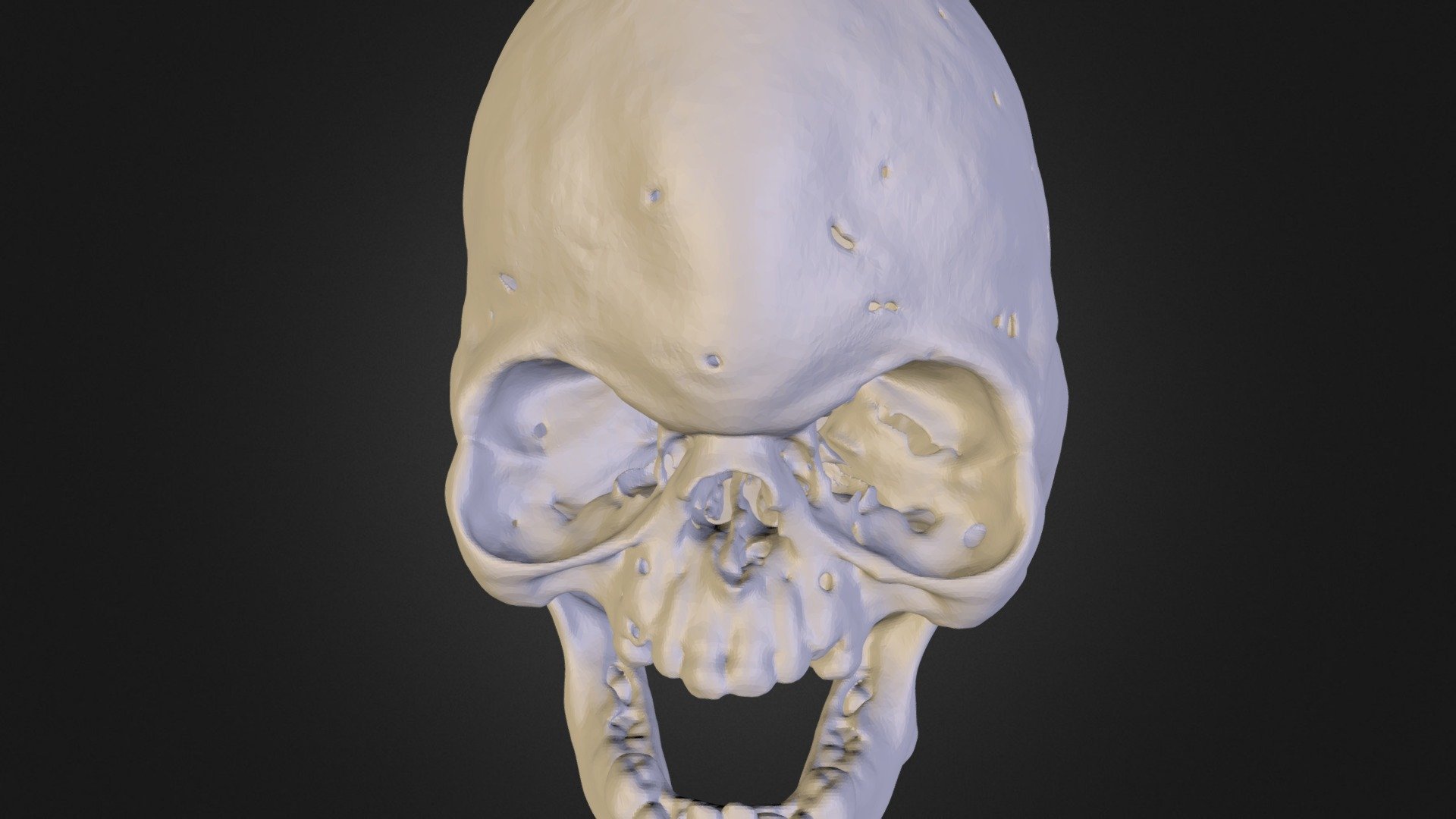 5 year old Aperts Skull